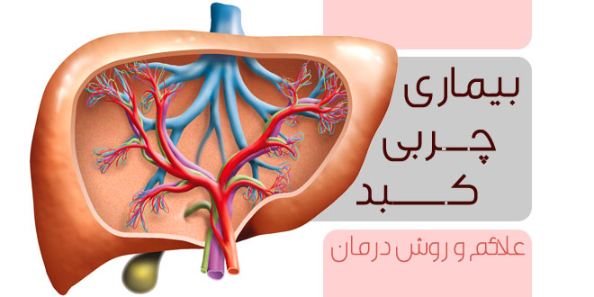 Znalezione obrazy dla zapytania علایم بیماری چربی کبد و راههای درمان