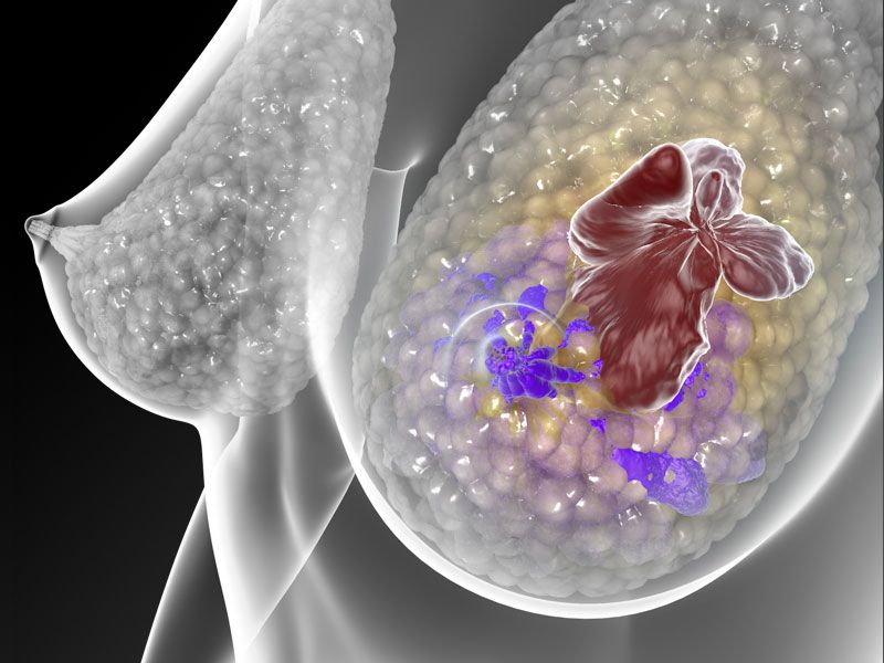 هورمون درمانی خطر ابتلا به سرطان پستان را 3 برابر می کند