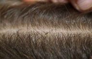 درمان شپش موی سر با اسپند