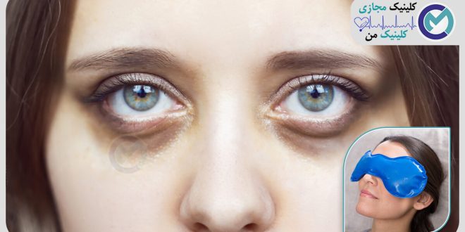 رفع تیرگی اطراف چشم