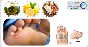 ساده ترین درمان برای میخچه و پینه