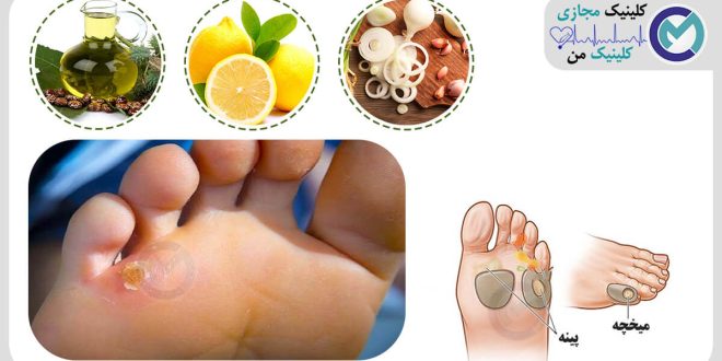 ساده ترین درمان برای میخچه و پینه