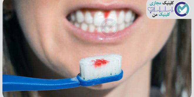 Complications-of-not-brushing