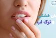 Treatment-dry-and-leave-lips