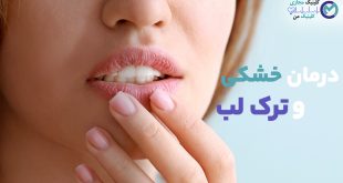 Treatment-dry-and-leave-lips