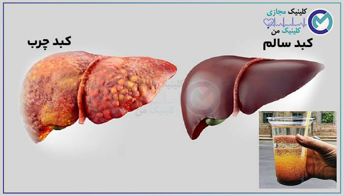 Treatment-of-fatty-liver-with-descurainia-sophia