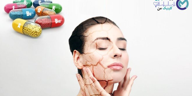 Vitamin-deficiency-and-its-symptoms-on-the-face