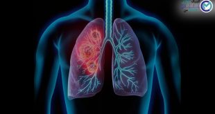 Treating-type-of-lung-cancer-with-the-help-of-vaccine
