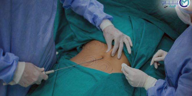 Liposuction