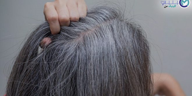 gray-hair-treatment