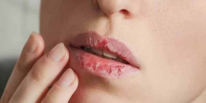 Vitamin-deficiency-and-dry-lips